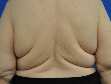 bra line backlift before