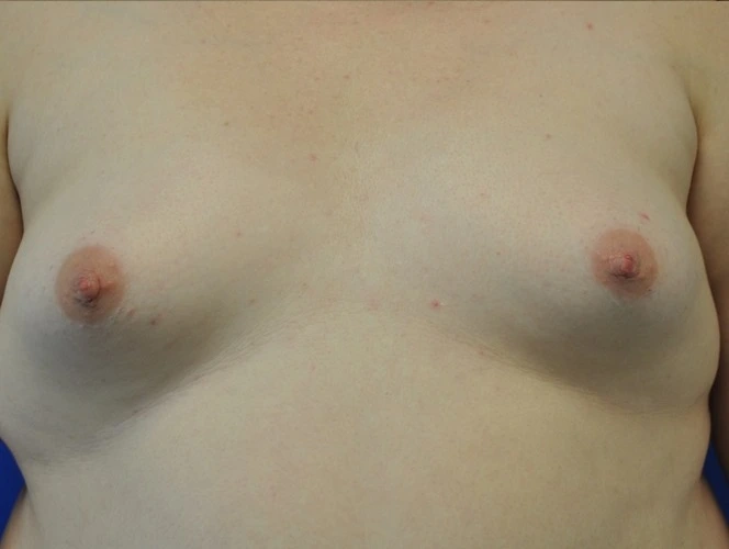 Patient 3269 Nipple Inversion After