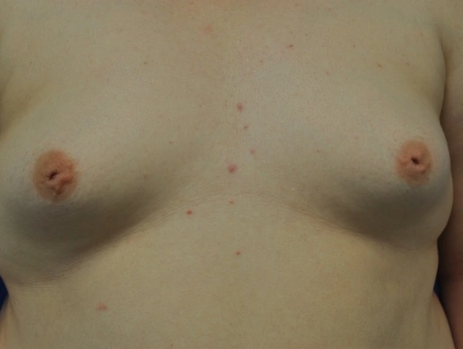 Patient 3269 Nipple Inversion Before