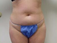 abdominoplasty tummy tuck before photo