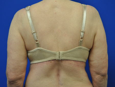 bra line backlift after