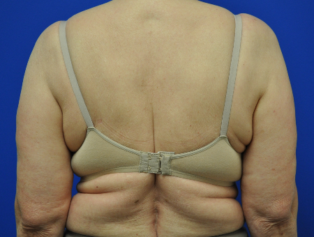 bra line backlift before